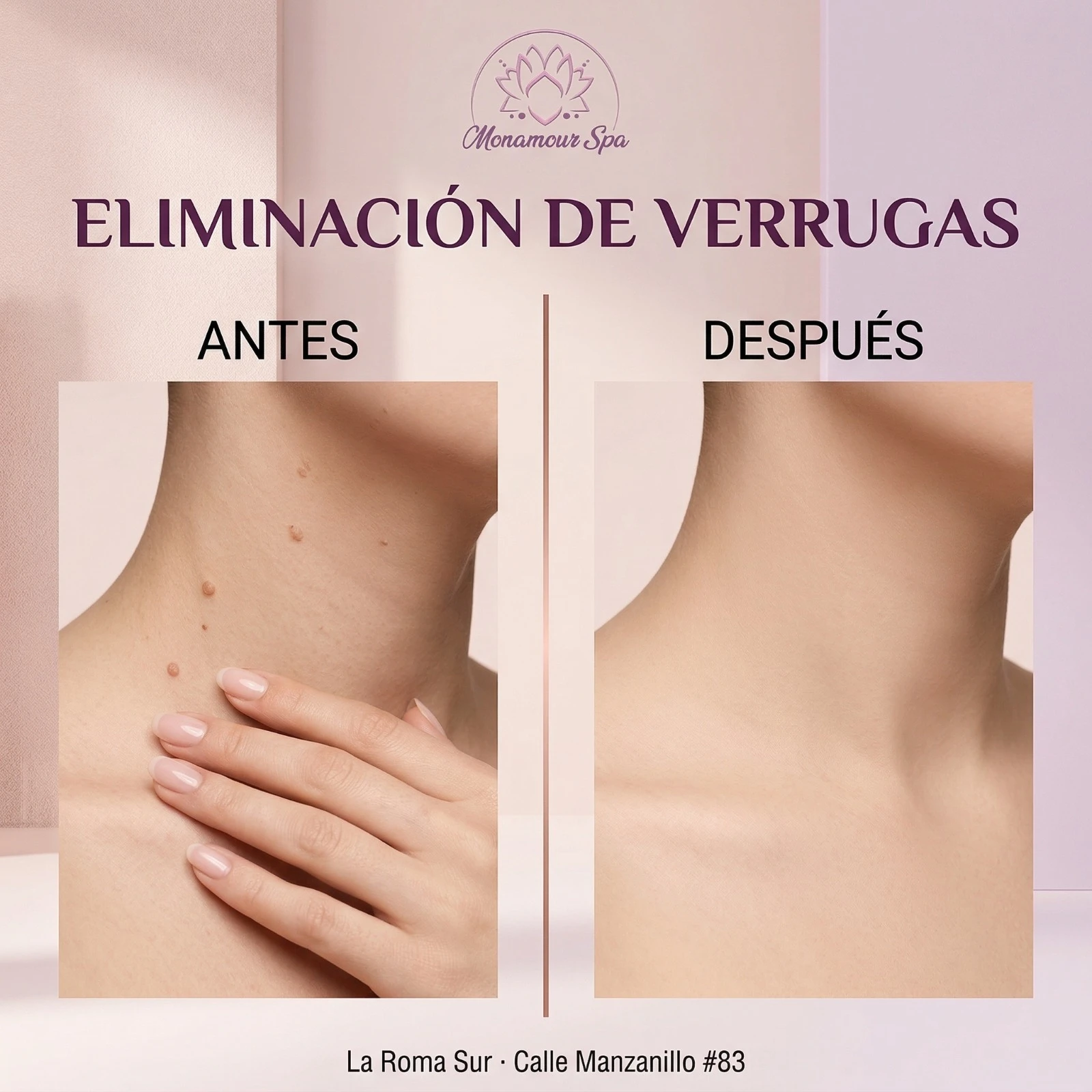 Eliminación de verrugas de UNA HORA 